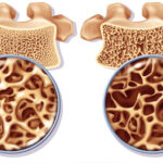 smoking-3-osteoporosis