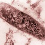tubercolosi