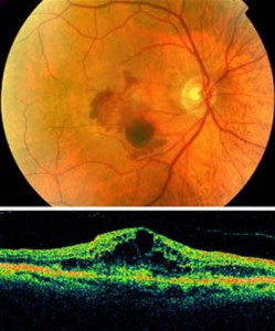 Macular degeneration 249x300 Degenerazione maculare senile: scoperti nuovi importanti fattori chiave