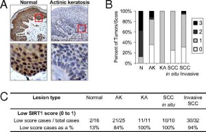SIRT1 300x192 Tumori: bloccato il canale di nutrimento delle cellule cancerose