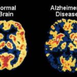 alzheimer