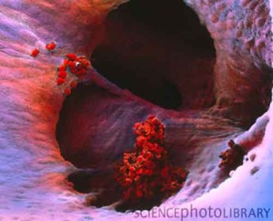 blood clots 300x243 Coaguli: dalla GB tecnica aspirapolvere, per liberare da ostruzioni presenti sulle autostrade del sangue