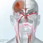 ictus_ischemia