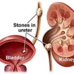 kidney-stones