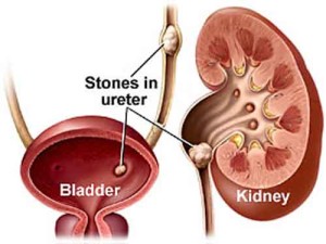 kidney stones 300x225 Tè freddo, dissetante ed estivo, ma se troppo mette a rischio salute reni