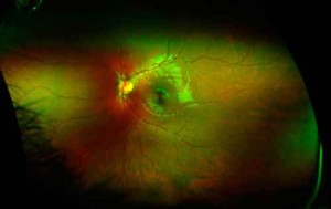 optomap image 300x189 Quando gli occhi rivelano problemi cardiaci