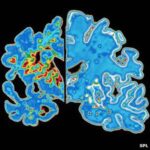 alzheimer