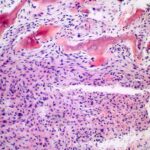 granuloma