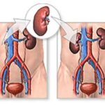 kidneytransplant