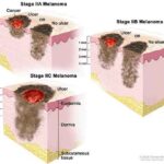 melanoma