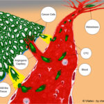 metastasis-diagram-l