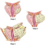 prostate