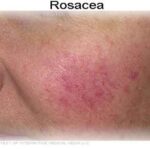 rosacea