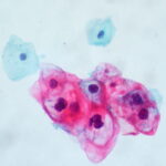 HPV