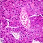 carcinoma_epatocellulare