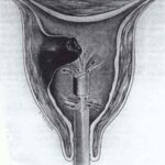 endometrio
