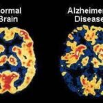 Alzheimers-Disease