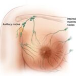Breast-Cancer