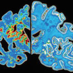 alzheimer