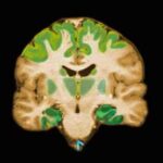 alzheimers_disease_brain