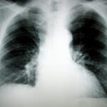 lungcancer-head