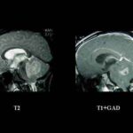medulloblastoma