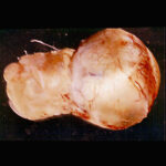 microftalmia