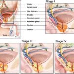 cancro_prostata