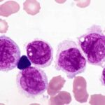leucemia