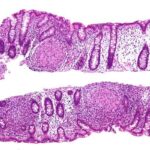morbo_crohn