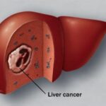 liver_cancer
