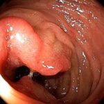 cancro_colorettale