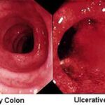 morbo_crohn