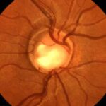 Glaucoma