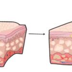 batteri_acne