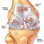 osteoartrite
