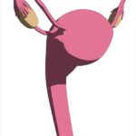 prolasso