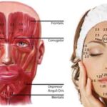 botox