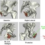 cancro_prostata
