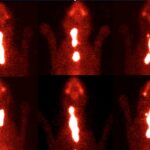 cancro_tiroide