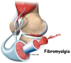 Fibromialgia: affligge 290.000 lombardi