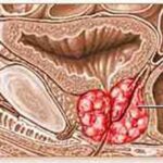 prostate-cancer
