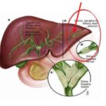 forme-intraepatiche