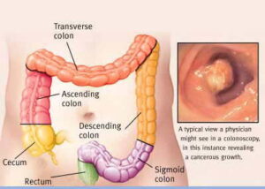 descrizione del tratto colon-rettale e colonscopia che rivela una crescita cancerosa
