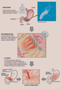 Schema che illustra rapporto e azione tra batterio e stomaco