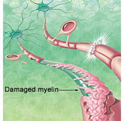 Rivestimento mielinico su un assone, danneggiato