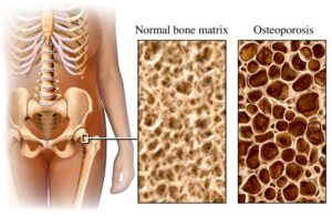 L'immagine mostra un'evidente alterazione della struttura ossea (destra)