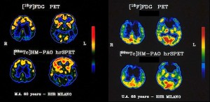 Immagini tomografiche PET (metabolismo di glucosio) e SPECT (perfusione) a due diversi livelli in un paziente affetto da malattia di Alzheimer (sinistra) e in un paziente con demenza frontotemporale (destra) 