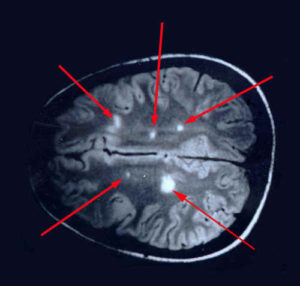 Una risonanza magnetica evidenzia le lesioni cerebrali