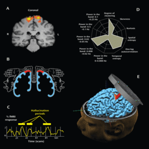 Transcranial magnetic stimulation (TMS)